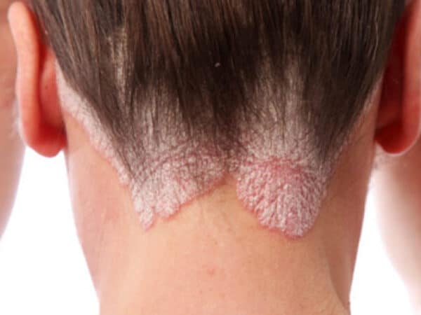 ROTINA IDEAL PARA QUEM TEM PSORÍASE CAPILAR: CUIDADOS DIÁRIOS PARA ALIVIAR DESCONFORTOS E PROTEGER O COURO CABELUDO