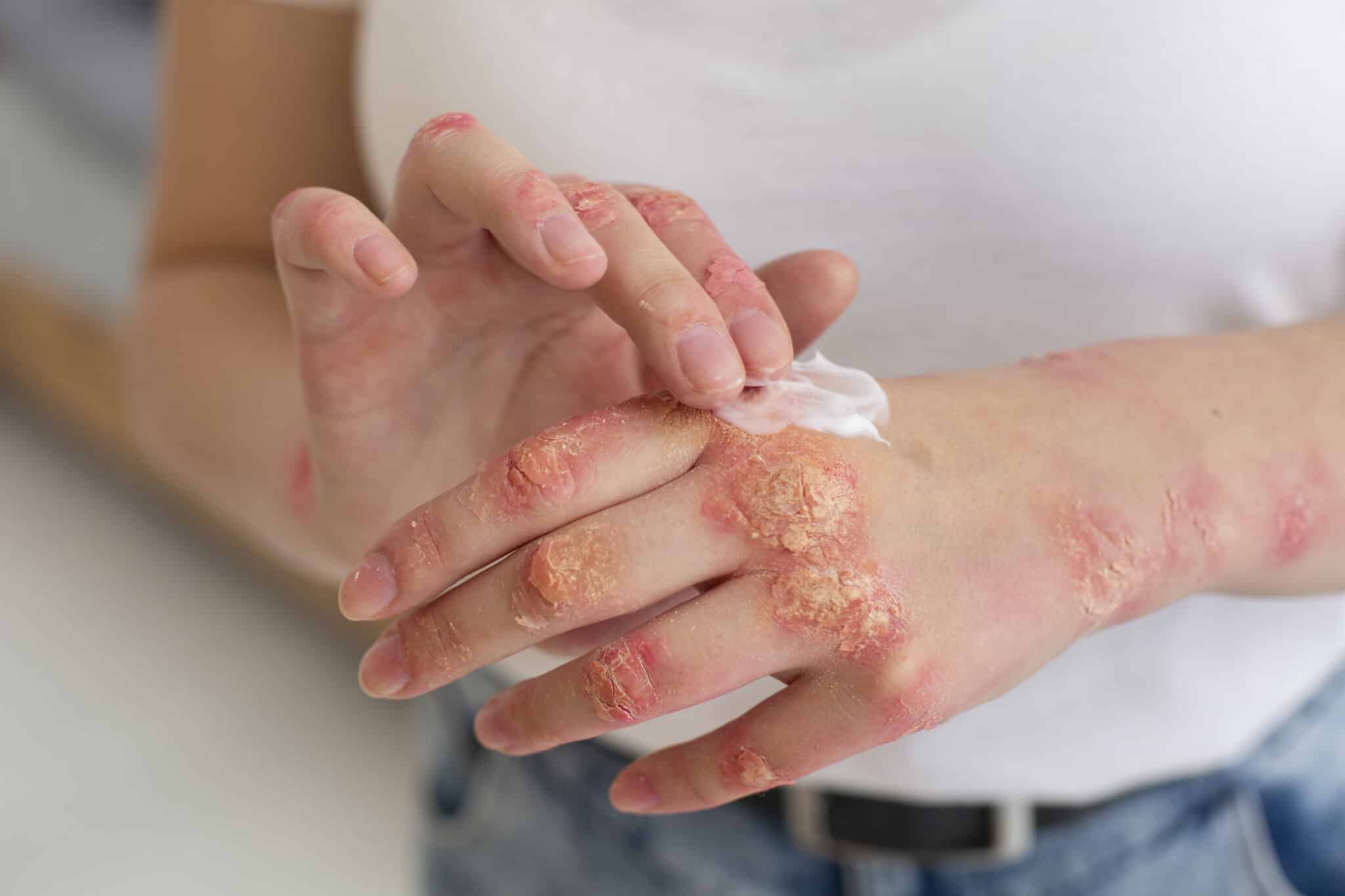 PSORÍASE E HIDRATAÇÃO: GUIA COMPLETO PARA CUIDAR DA PELE RESSECADA E ALIVIAR OS SINTOMAS