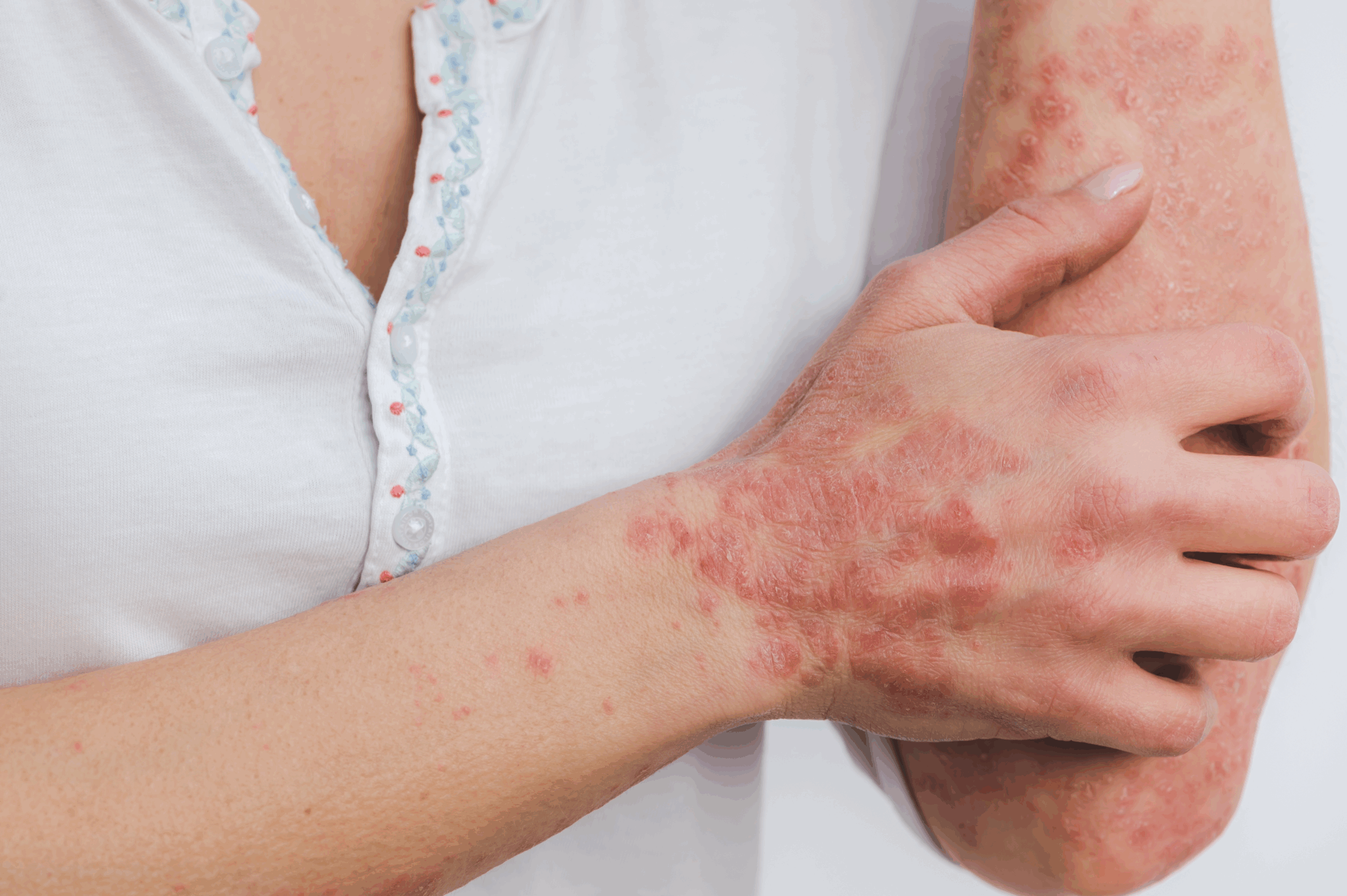 PSORÍASE OU ALERGIA? DESCUBRA COMO DIFERENCIAR DOENÇAS DE PELE PARECIDAS