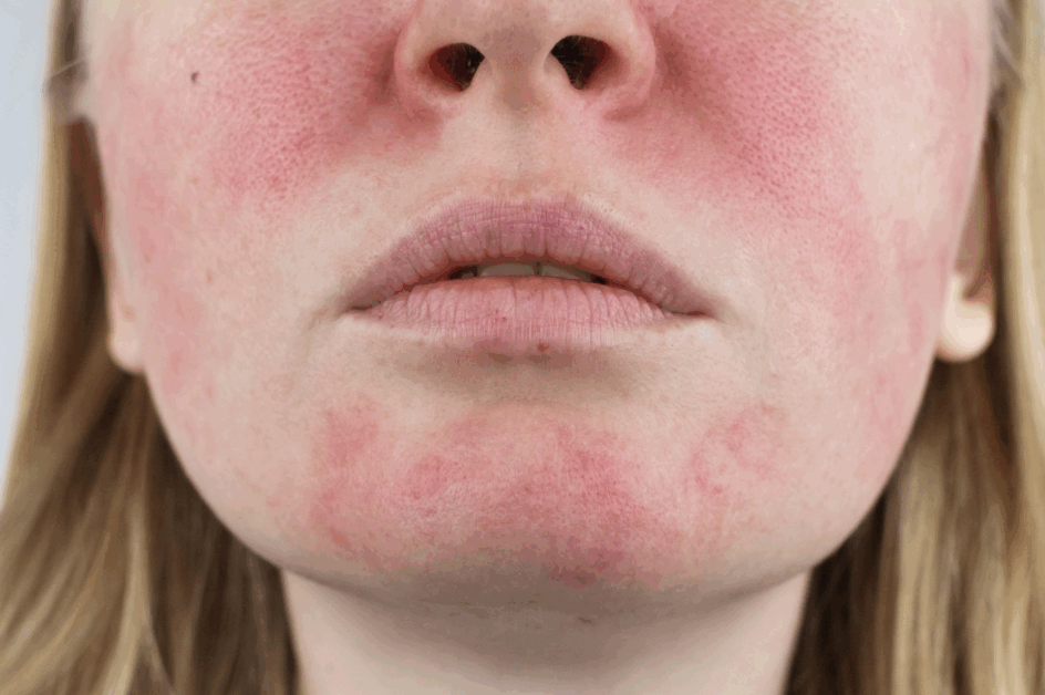 cuidados com a pele com rosácea