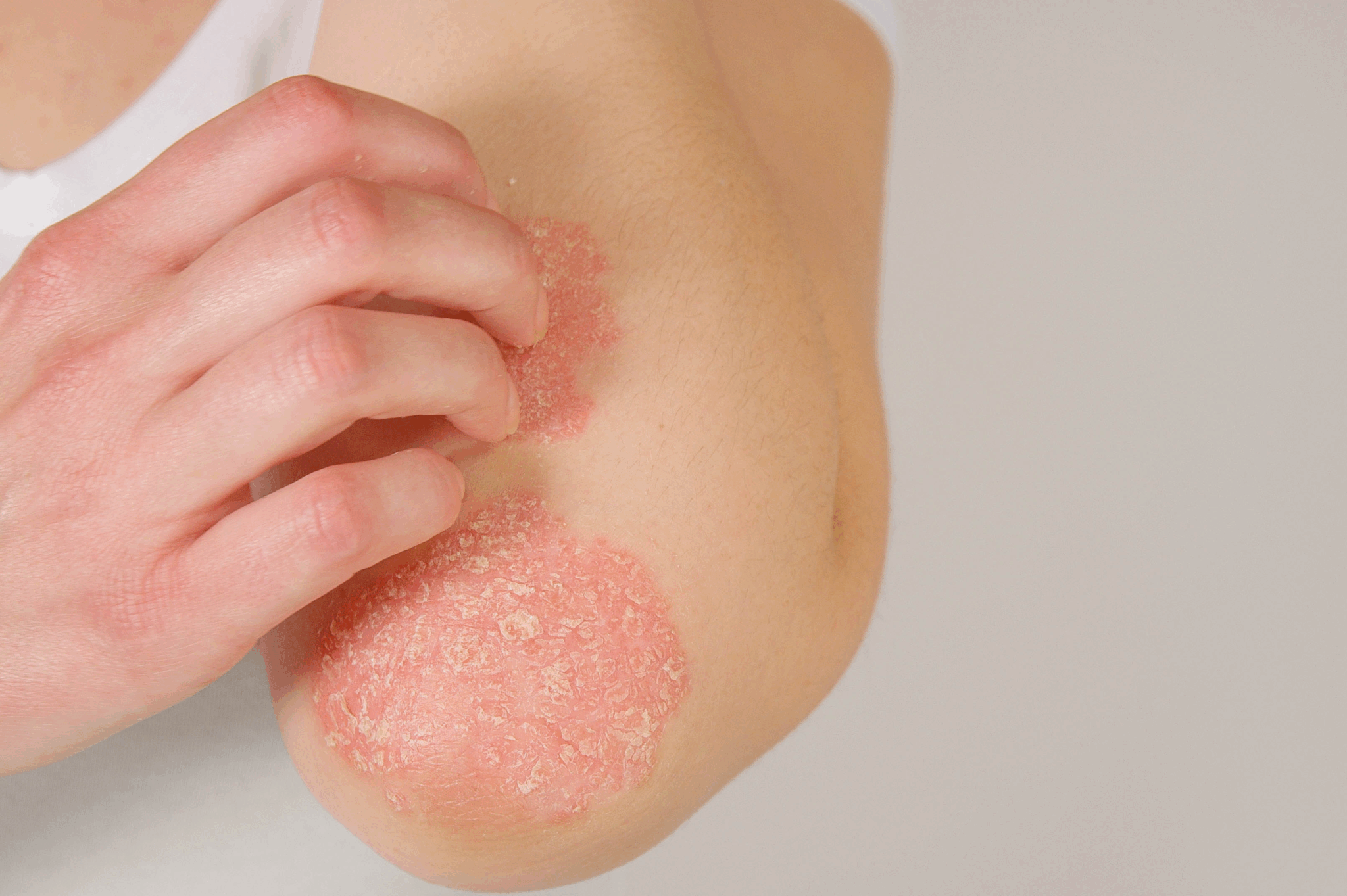 LESÕES DE PSORÍASE: ONDE APARECEM E QUAIS SÃO SUAS PRINCIPAIS CARACTERÍSTICAS