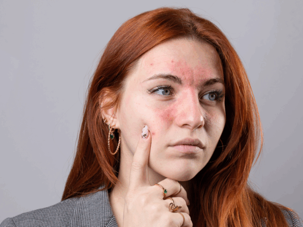 5 CUIDADOS PARA A PELE COM ROSÁCEA QUE VOCÊ PRECISA SABER