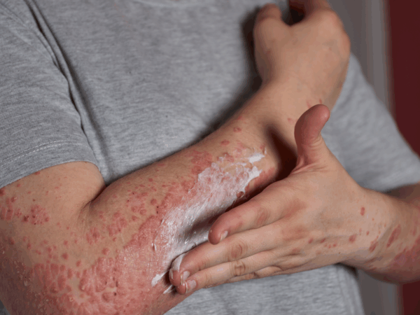 MUDANÇAS DE TEMPERATURA E PSORÍASE: ENTENDA POR QUE SUA PELE PIORA NO FRIO