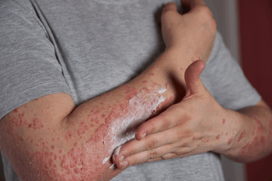 cosméticos manipulados para psoríase