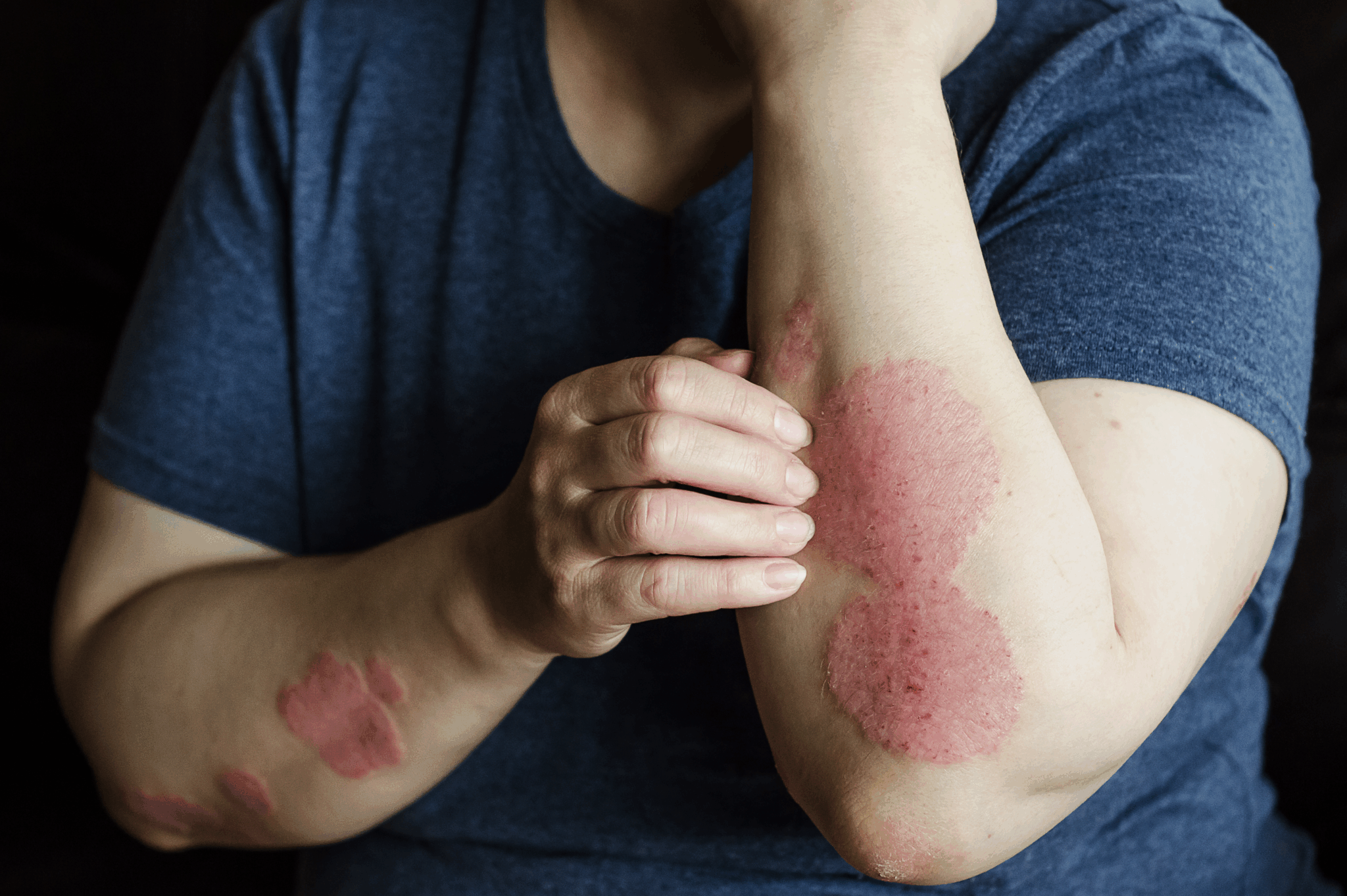 psoríase além da pele