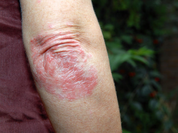 PSORÍASE X DERMATITE: ENTENDA A DIFERENÇA