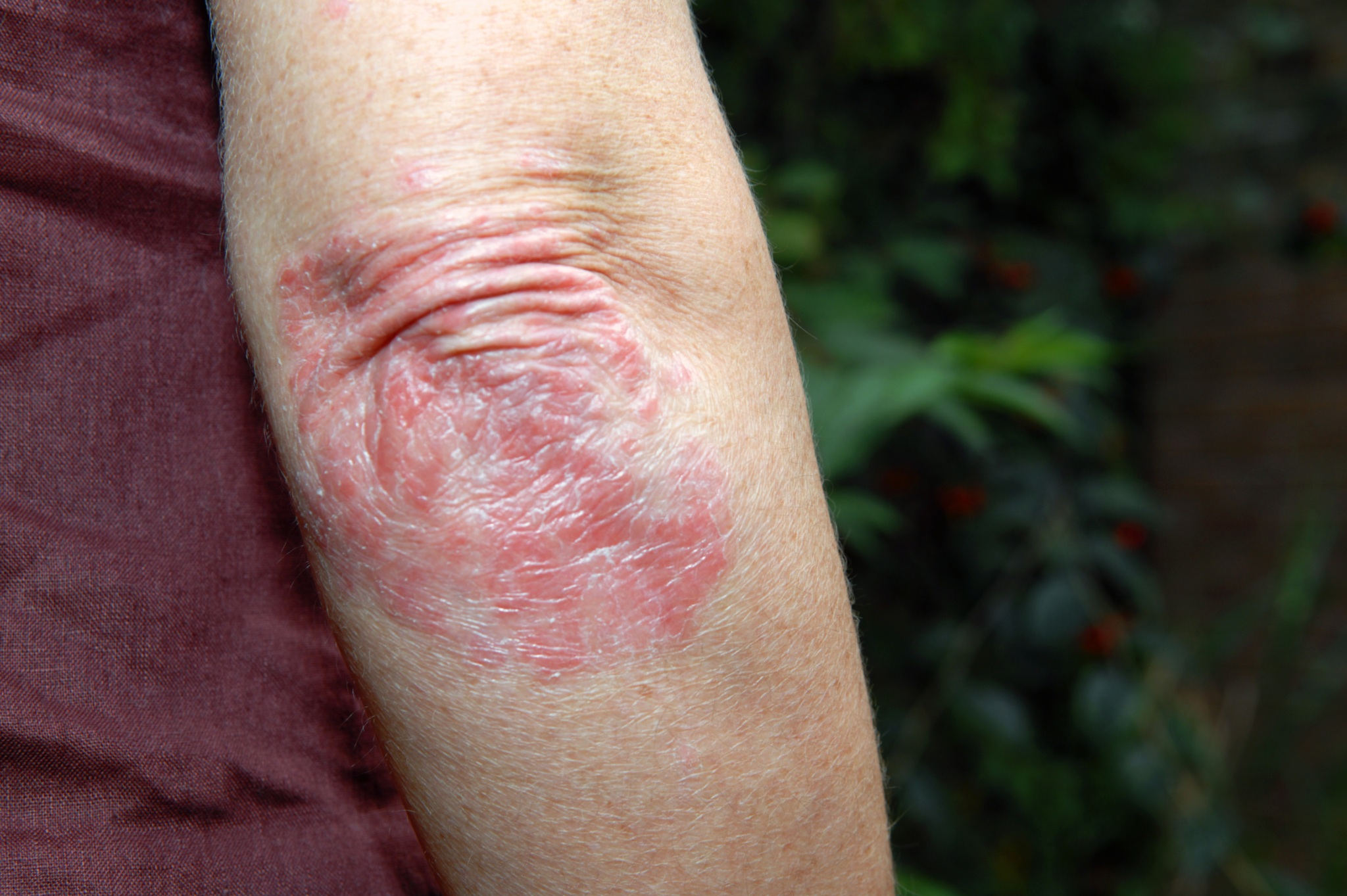 PSORÍASE X DERMATITE: ENTENDA A DIFERENÇA