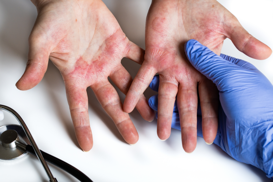 psoríase e dermatite